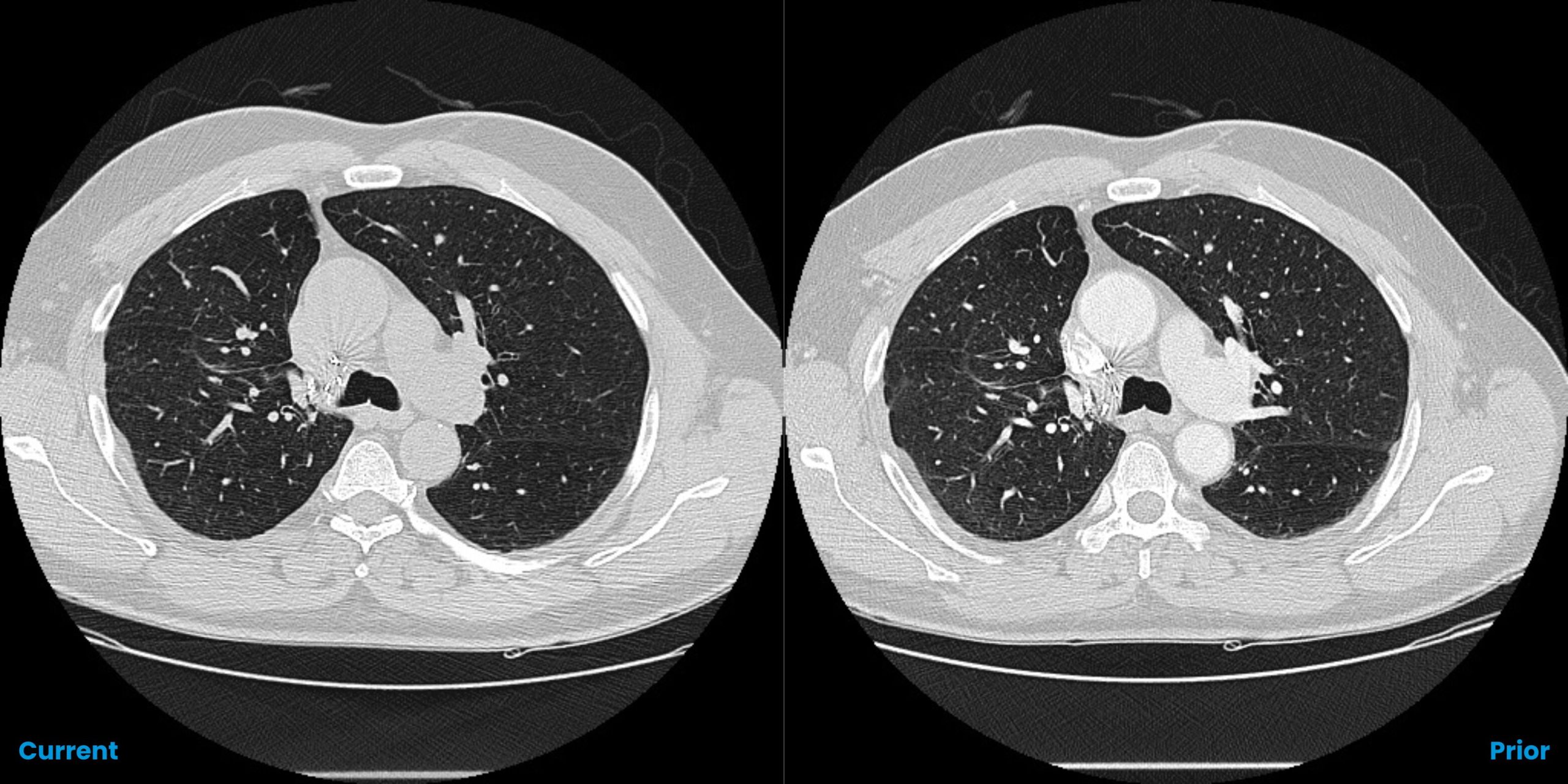 ClearRead CT Compare module displaying current and prior axial CT scans at the lower lung level, facilitating radiologist assessment of interval changes in lung nodules.