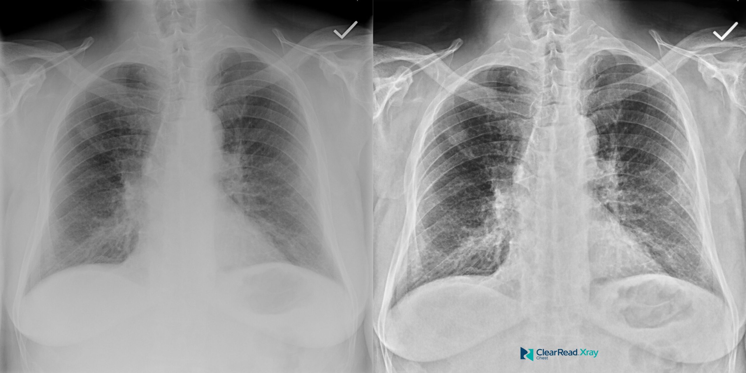 ClearRead Xray paired chest radiographs showing original and bone-suppressed views with enhanced lung field visualization, demonstrating AI-powered rib suppression technology.