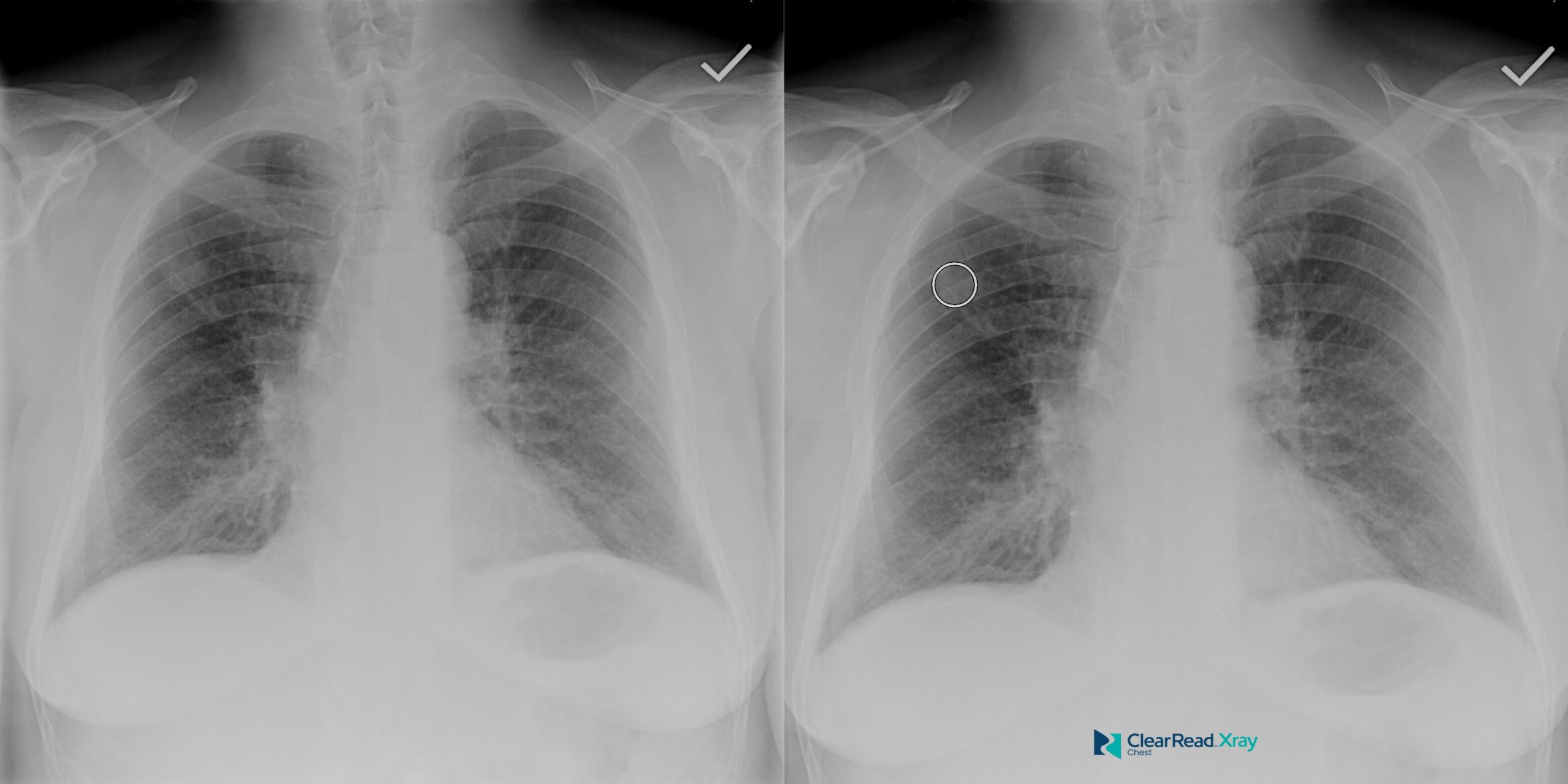 ClearRead Xray processed PA chest radiographs displayed side by side with AI analysis completion indicators, showing bone-suppressed views for enhanced diagnostic review.