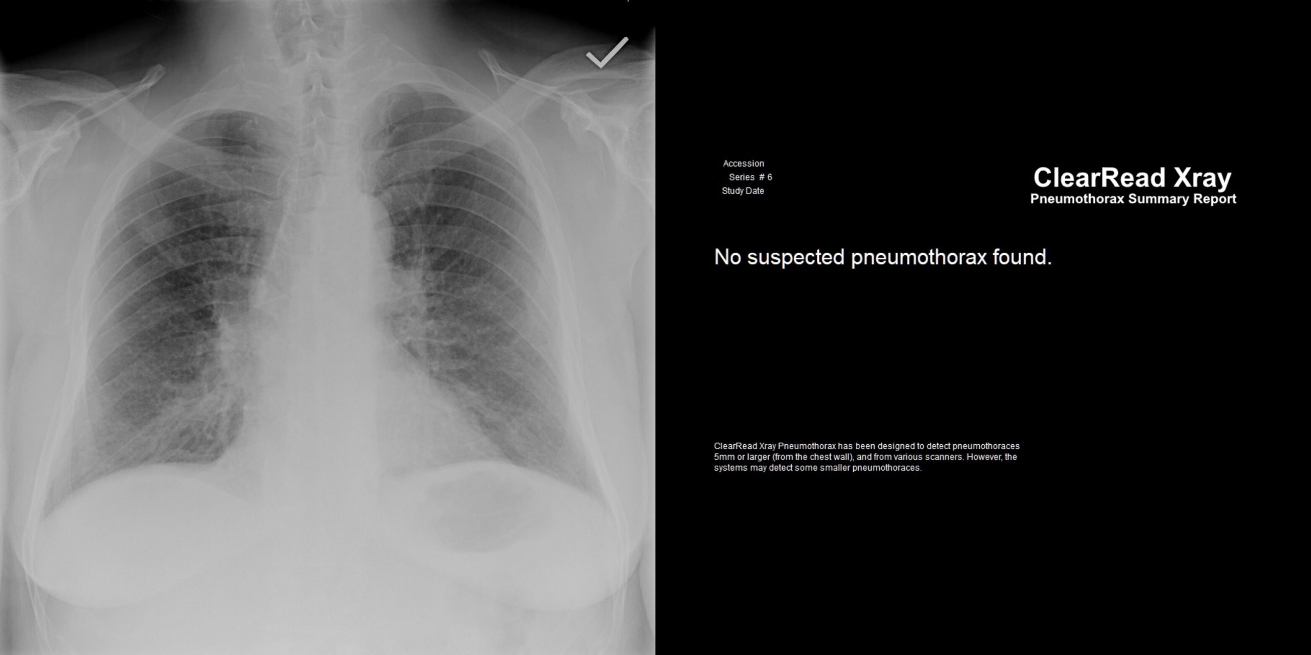 ClearRead Xray Pneumothorax Summary Report displaying a bone-suppressed chest radiograph with no suspected pneumothorax found, demonstrating AI-powered pneumothorax screening.