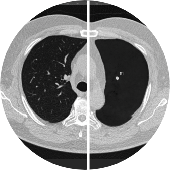 ClearRead CT comparison image showing an axial chest CT with AI-identified lung nodule, illustrating how the software enhances nodule detection for radiology workflows.