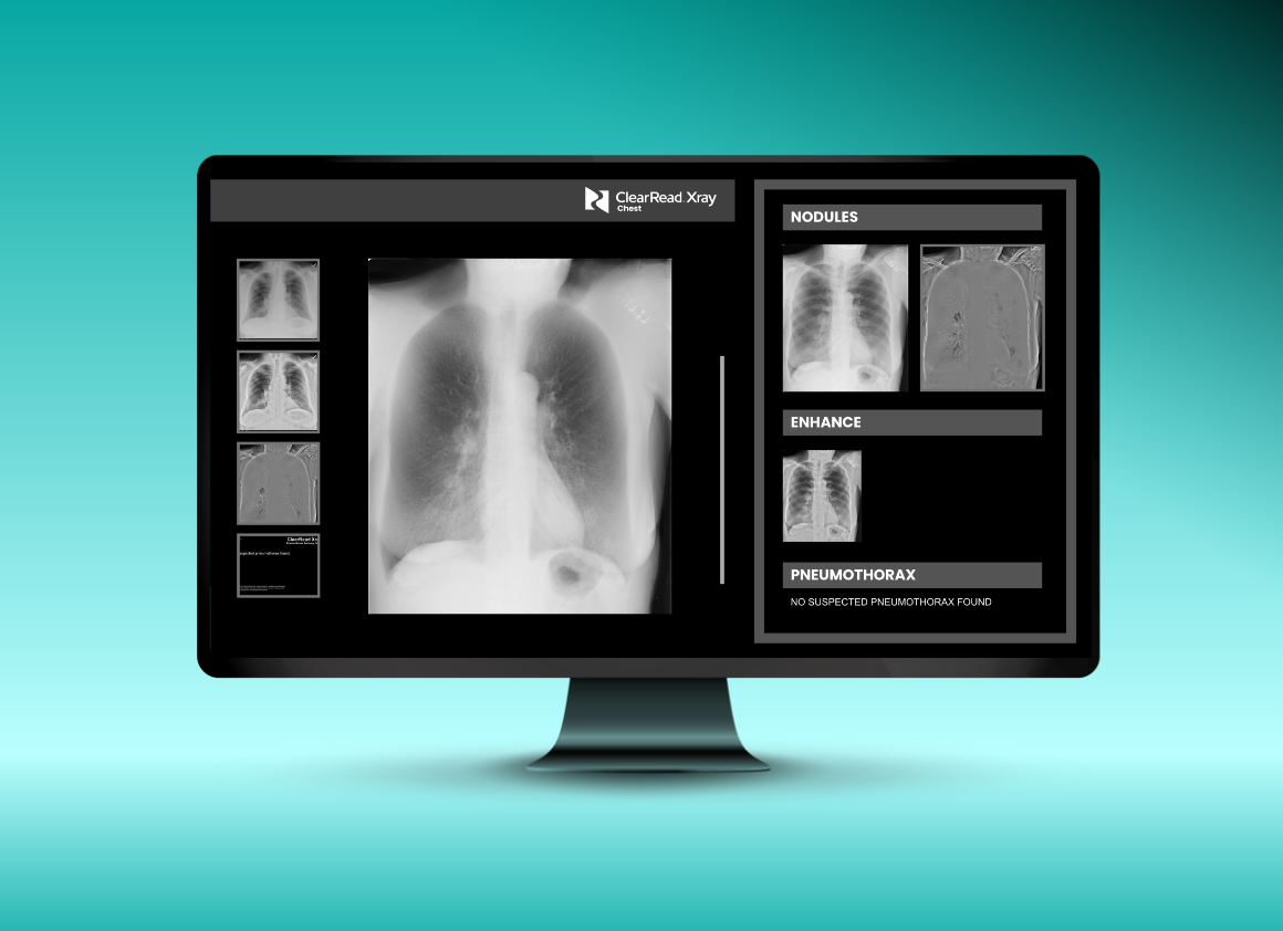 Desktop monitor displaying the ClearRead Xray Chest interface on a teal gradient background, featuring a full chest X-ray with AI-powered nodule detection, bone suppression enhancement, and pneumothorax screening panels.