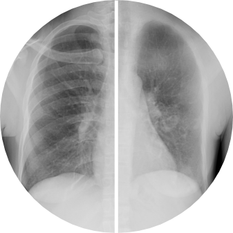 ClearRead Xray before-and-after comparison displaying an original chest radiograph alongside the bone-suppressed version, demonstrating AI-enhanced soft tissue visualization.