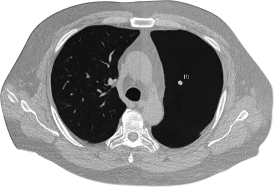 Original unprocessed axial chest CT scan at lung window demonstrating standard radiological appearance before ClearRead CT AI-powered image enhancement processing.