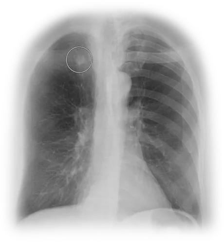 Posteroanterior chest radiograph used as a ClearRead CT reference graphic, demonstrating the baseline imaging Riverain Technologies AI analyzes for nodule detection and bone suppression.