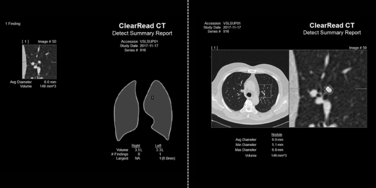 Clearread CT Chest - Riverain Tech