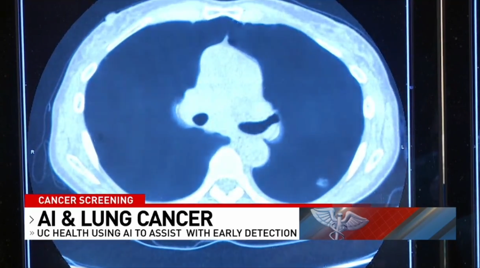 UC Health using ClearRead CT for lung cancer screening