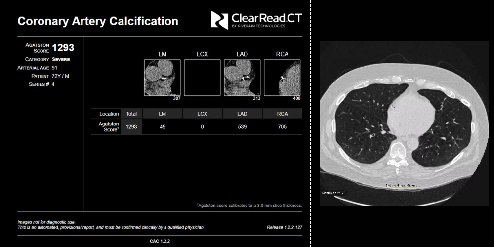 A radiologist examines chest radiographs across multiple monitors in a clinical setting, showcasing the advanced AI-powered technology behind Riverain Technologies' diagnostic platform.