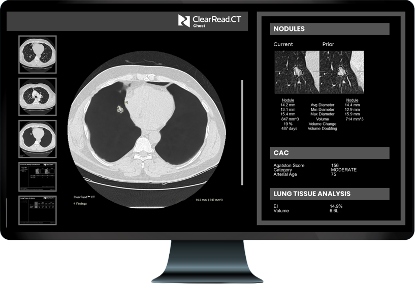 A radiologist examines chest radiographs across multiple monitors in a clinical setting, showcasing the advanced AI-powered technology behind Riverain Technologies' diagnostic platform.