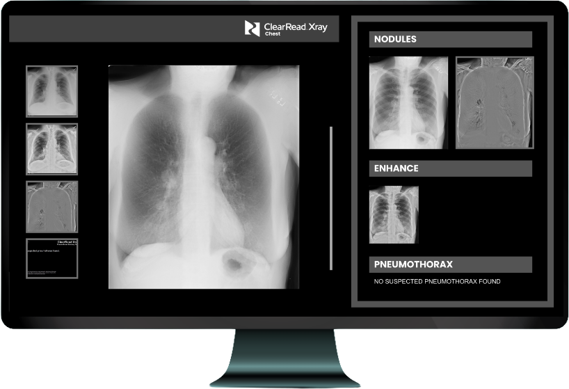 A radiologist examines chest radiographs across multiple monitors in a clinical setting, showcasing the advanced AI-powered technology behind Riverain Technologies' diagnostic platform.